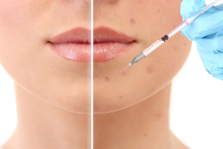 Как убрать подкожный прыщ на лице: в домашних условиях и косметическими средствами