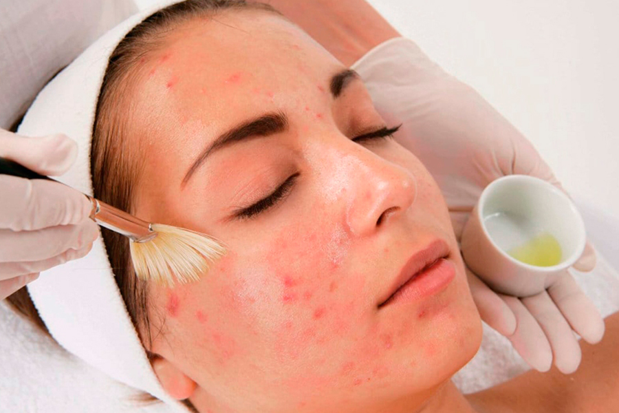 Как убрать подкожный прыщ на лице: в домашних условиях и косметическими средствами