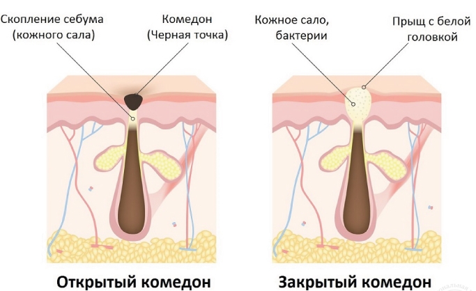 Как убрать подкожный прыщ на лице: в домашних условиях и косметическими средствами