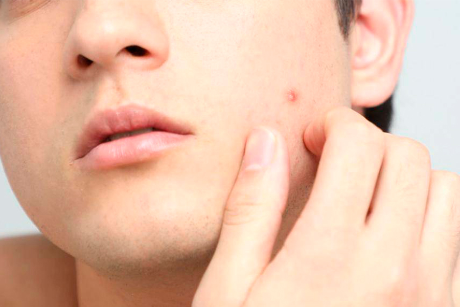 Как убрать подкожный прыщ на лице: в домашних условиях и косметическими средствами