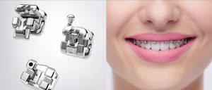 Самолигирующие брекеты H4: характеристики и достоинства