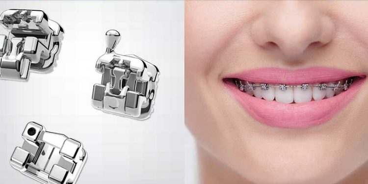 Самолигирующие брекеты H4: характеристики и достоинства