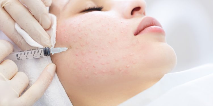 Мезотерапия, или как вернуть коже молодость