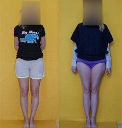 Увеличение роста: каким образом удлиняются ноги?