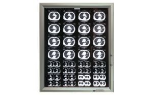 Негатоскоп: виды и назначение