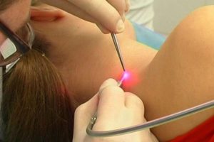 Как удалить бородавку