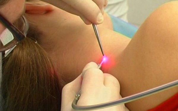 Как удалить бородавку