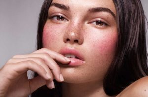 Акне и розацеа: отличия и лечение гелем Азелик