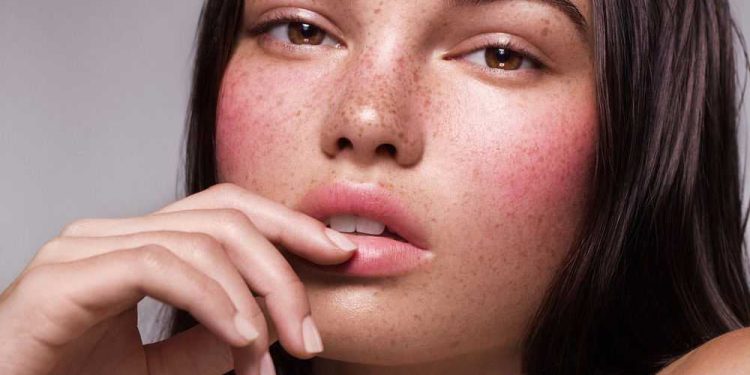 Акне и розацеа: отличия и лечение гелем Азелик