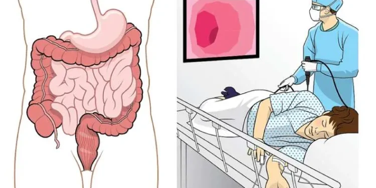 Когда нужно проходить колоноскопию