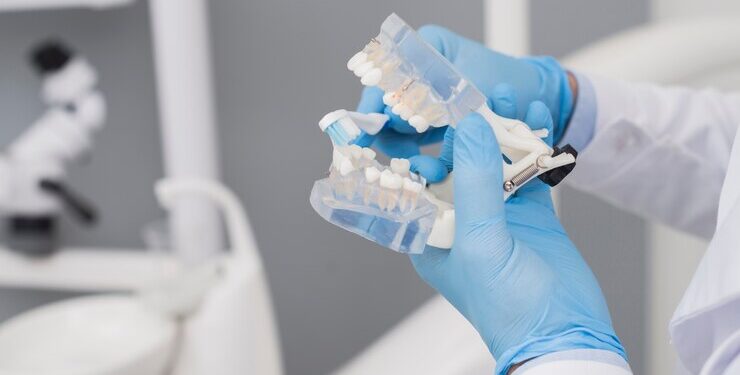 Что такое имплантация зубов на 4 имплантах