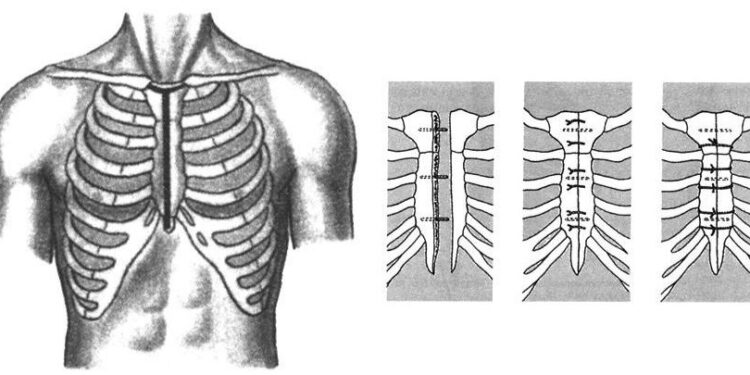 Что такое стернотомия